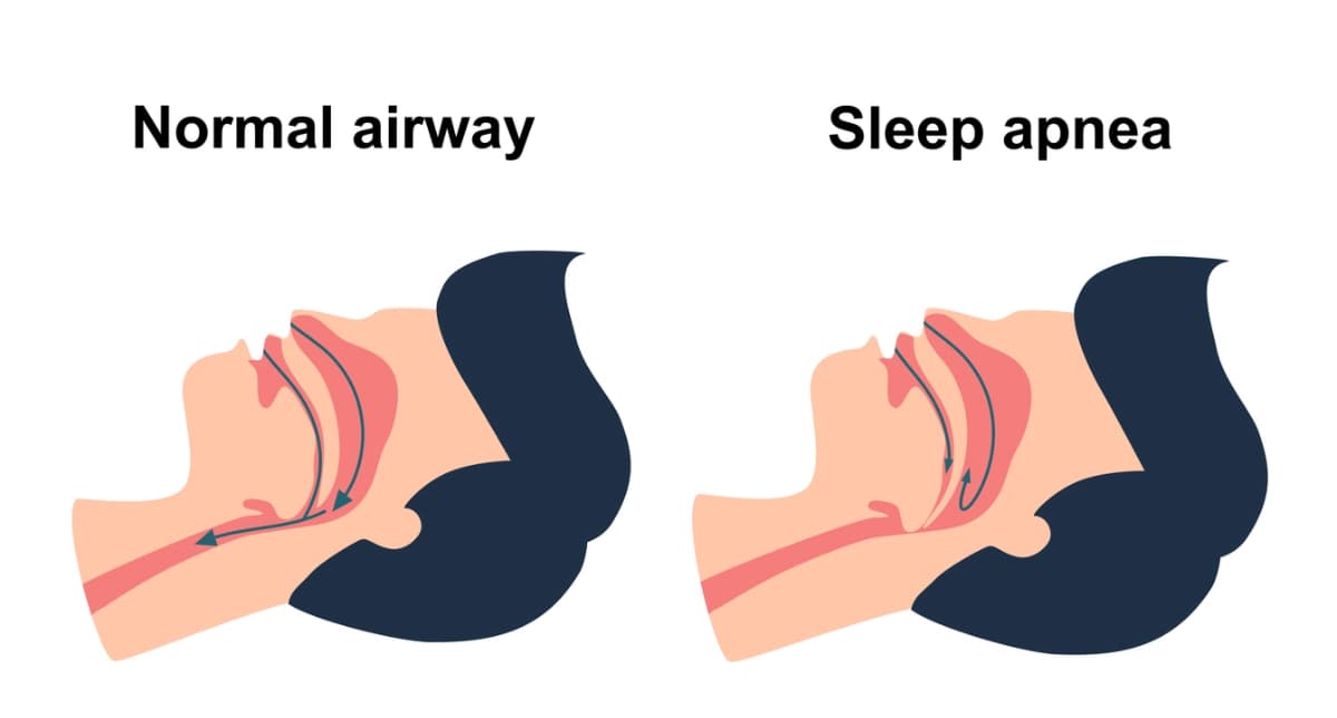 Snoring vs Sleep Apnea: How to Know the Difference