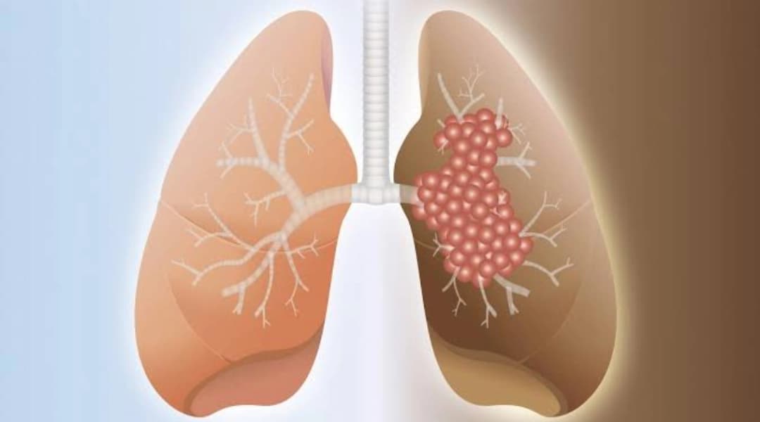 Lung Fibrosis Symptoms: Early Signs, Causes and Treatment Options