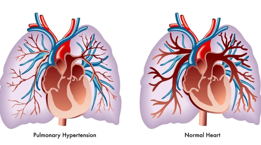Pulmonary Hypertension: Symptoms, Causes and Treatment