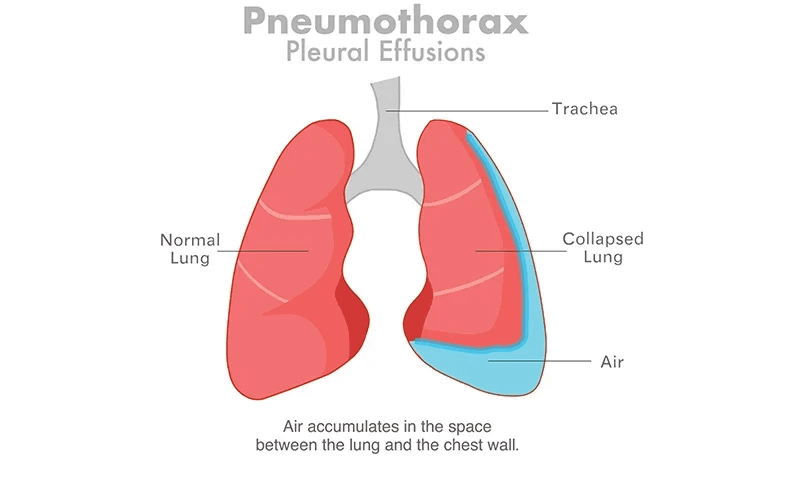 Pleural Effusion: Symptoms, Causes, Diagnosis and Treatment