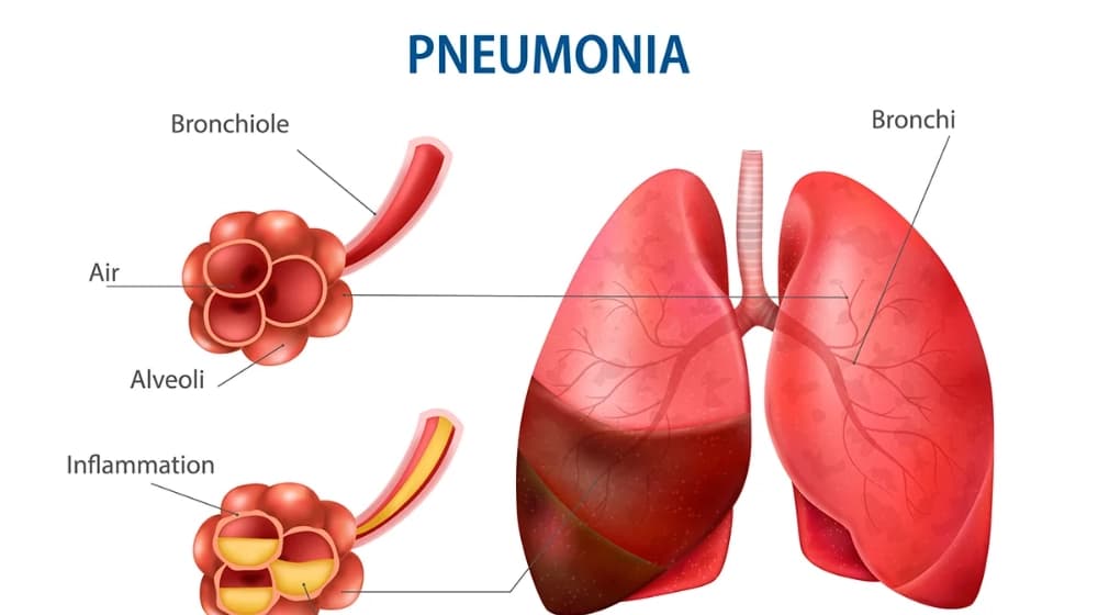 Lung Infection vs Pneumonia: Symptoms, Causes and Key Differences